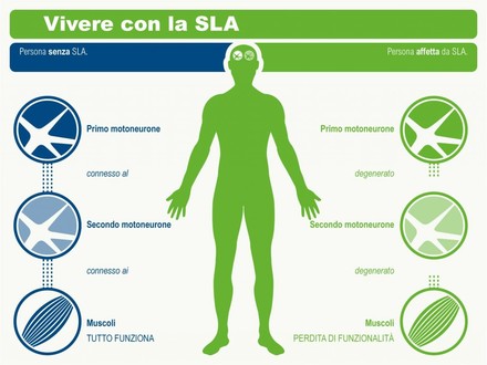 Medicina: tra due anni un test rileverà la SLA