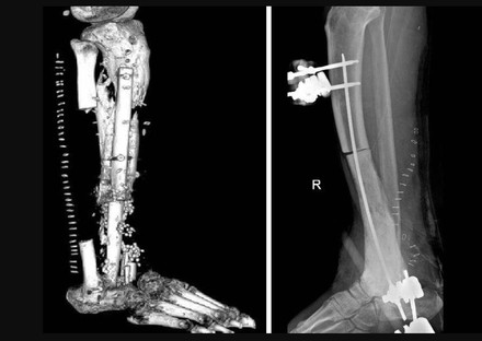 Batterio gli 'mangia' la carne, operazione al Gemelli lo salva